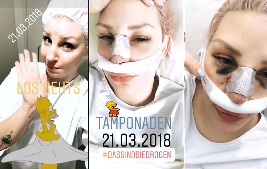 BTN-Paula: Laura Maack zeigt sich erstmals nach Nasen-OP! | Fotos
