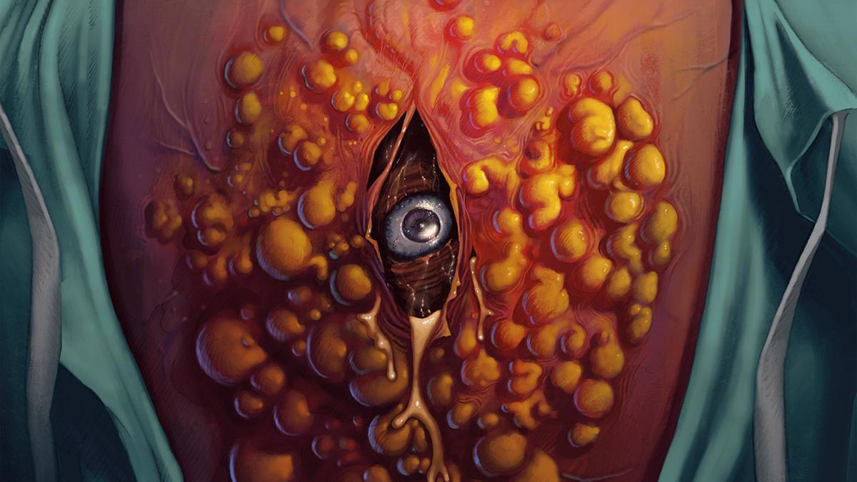 Cyst Cyst
