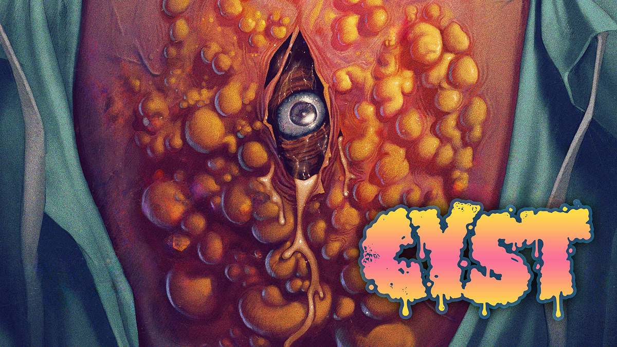cyst