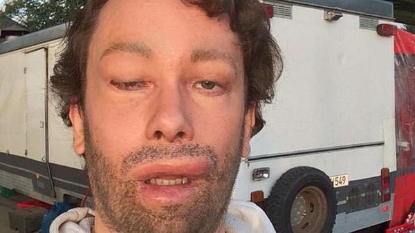 Christian Ulmen: Botox-Unfall?!   - Foto: Christian Ulmen/Facebook