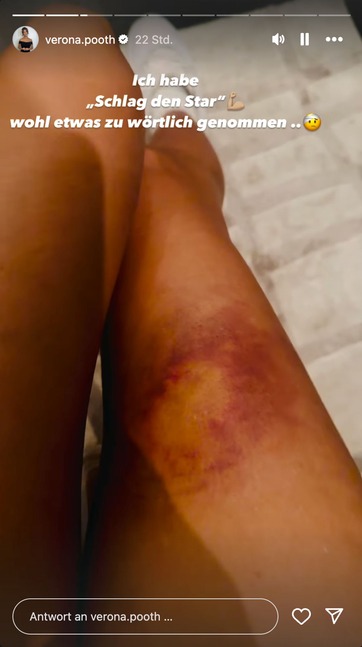 Veronas Bein schmückt ein großes Hämatom in dunklen und gelben Farben.  